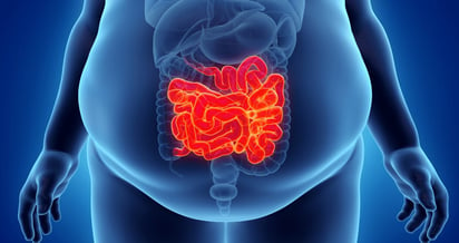 Adiposidad visceral y exacerbación de la enfermedad inflamatoria intestinal