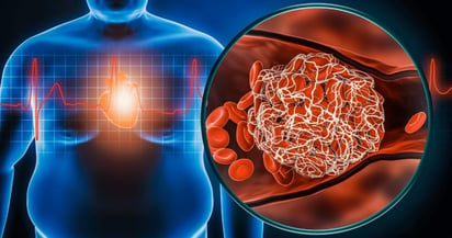 La miocardiopatía por obesidad se relaciona con muerte súbita cardiaca