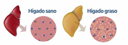 La esteatosis hepática no alcohólica es frecuente, pero puede remitir