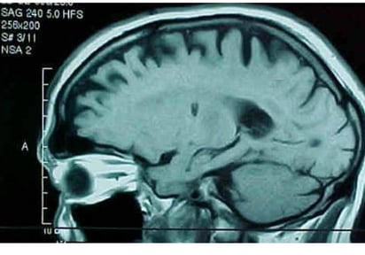 Este estudio cambia el escenario para los tumores cerebrales