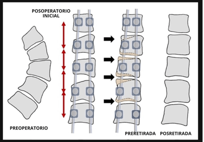 Una nueva técnica permite la corrección precoz de la escoliosis sin corsés