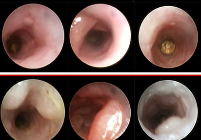 Estas mutaciones en las células madre de la sangre favorecen el cáncer de colon