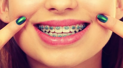 Como cuidar de tus brackets para volverlos el mejor accesorio: Que tu aparato dental se vuelva tu aliado para lucir increíble.