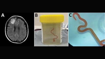 Unos médicos extrajeron una lombriz viva del cerebro de una mujer australiana