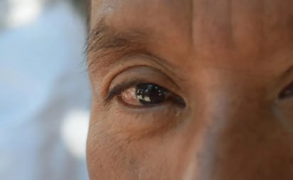 De qué son síntomas el derrame en un ojo y dolor de cabeza