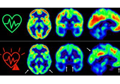 Explican la tóxica relación entre la aterosclerosis y el alzhéimer