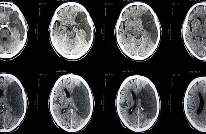 El uso de estatinas se asocia con un menor riesgo de un ictus posterior