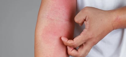 La dermatitis atópica puede ser un factor de riesgo en el embarazo