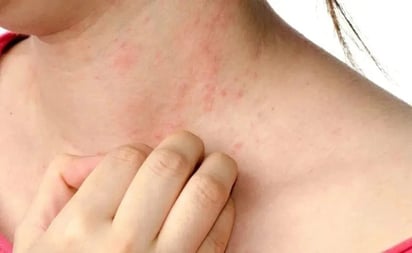 El 70% de los pacientes con dermatitis atópica tienen antecedentes genéticos