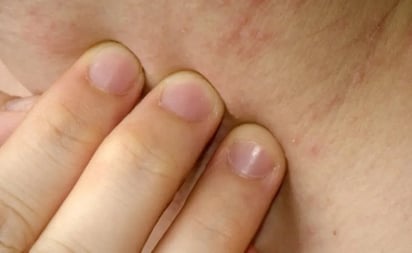 Día Internacional de la Dermatitis Atópica: acoso escolar también puede afectar a niños que padecen