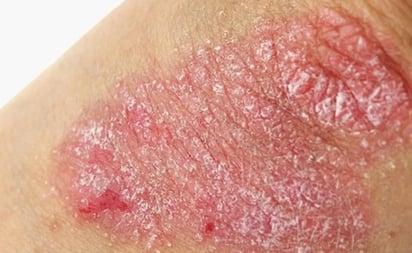 Psoriasis, enfermedad de la piel que impacta emocionalmente