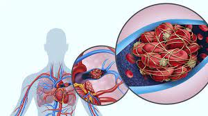 Tromboembolia pulmonar en embarazadas: ¡no dejarla pasar!