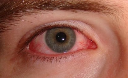 Conjuntivitis ¿qué es y cómo evitarla?