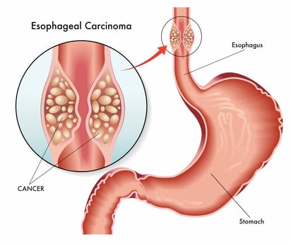 No hay riesgo adicional de cáncer de esófago en el reflujo no erosivo