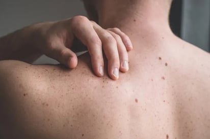 Biopsia del ganglio centinela, clave para el diagnóstico precoz del melanoma