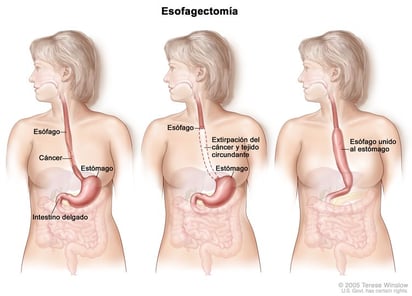 ¿Pueden evitar la cirugía algunos pacientes con cáncer de esófago?