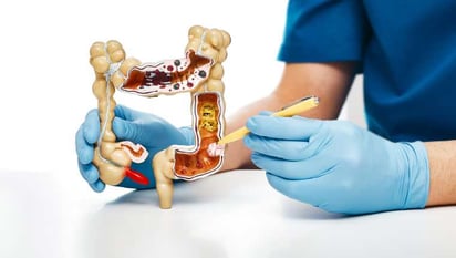 Cinco claves sobre el cáncer de colon que deben tener en cuenta las personas menores de 55 años