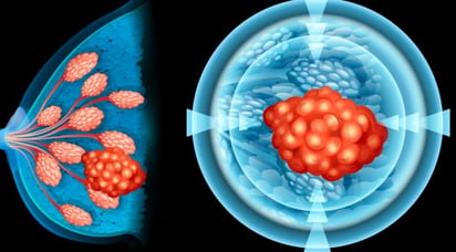 Biopsia líquida de leche materna: potencial predictor del cáncer de mama gestacional