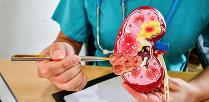 La detección precoz, clave para superar el cáncer renal