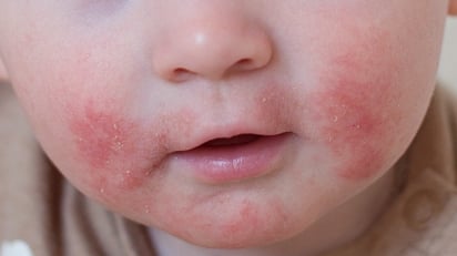 Ruxolitinib tópico para pacientes pediátricos con dermatitis atópica