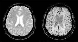 Relevancia del ictus minor en la enfermedad cerebrovascular