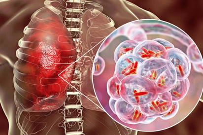 Registra Coahuila 662 muertes por tuberculosis: En 2022 fue la segunda causa de muerte, detrás del Covid-19