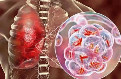 Coahuila suma 662 muertes por tuberculosis