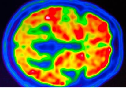 Un cóctel de fármacos para la hipertensión, eficaz en lesiones cerebrales graves