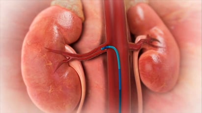 La denervación renal es una alternativa apoyada por las guías para la hipertensión arterial refractaria