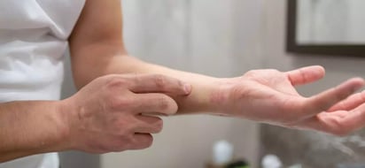 Abordaje del paciente pediátrico con dermatitis atópica y fototipo alto