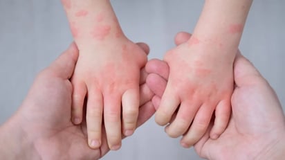 Los niños con eczema podrían necesitar más pruebas de alergia