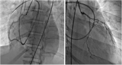 Aumenta la incidencia de la disección espontánea de arterias coronarias