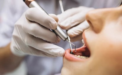 El peligro silencioso de las caries: ¿Qué sucede si no se tratan a tiempo?