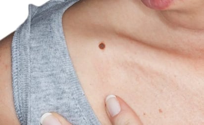 Lunares extraños, posible presencia de Melanoma: síntomas que debes conocer