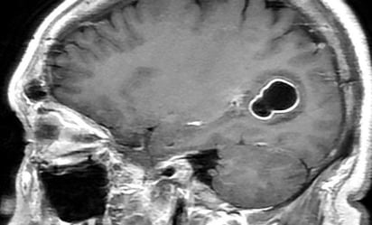 Implante bilingüe: Chip con IA permite a paciente con parálisis cerebral comunicarse en inglés y español