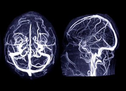 SALUD: Los investigadores evaluaron el riesgo de aneurismas cerebrales que provocan accidentes cerebrovasculares