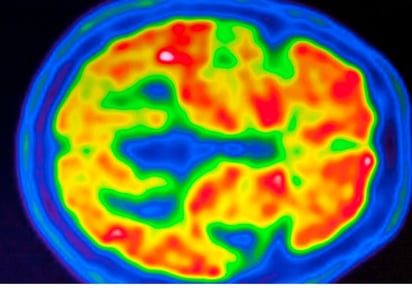 SALUD: La EMA considera que su efecto en el retraso del deterioro cognitivo no compensa el riesgo de efectos secundarios