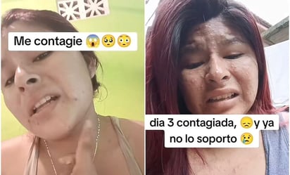 Joven confunde viruela del mono con varicela y se vuelve viral en TikTok