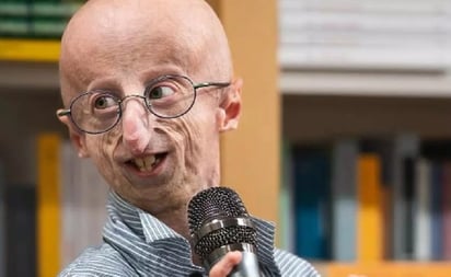 SALUD: La progeria es una condición genética que acelera el envejecimiento