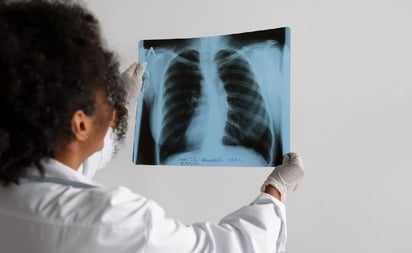 SALUD: En la región de las Américas, que incluye Norteamérica, Centroamérica, el Caribe y Sudamérica, la tuberculosis afecta a muchos