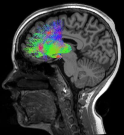 SALUD: Las personas con esquizofrenia generan patrones neuronales distintos