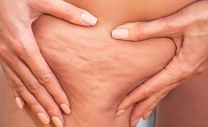 SALUD: La celulitis afecta a un alto porcentaje de mujeres