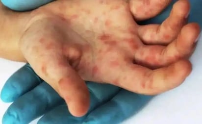 SALUD: El clado lb de mpox, la nueva variante del virus causante de la enfermedad, ha demostrado ser mas contagioso