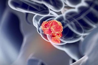 SALUD: Cada vez más adultos jóvenes desarrollan cáncer de colon en todo el mundo

