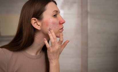 SALUD: La piel del rostro y de las manos es la que más sufre durante el invierno