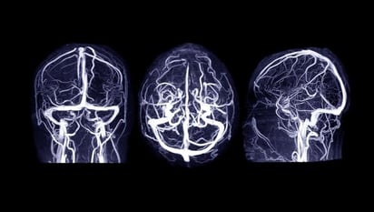 SALUD: El desarrollo del cerebro podría desempeñar un papel en los trastornos alimentarios

