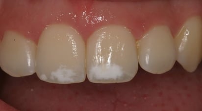 ¿Por qué aparecen manchas blancas en los dientes y cómo eliminarlas?