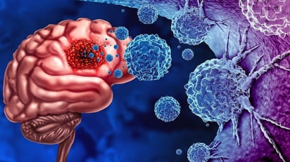 Rastros de bacterias encontrados en tumores cerebrales