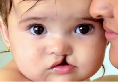 ¿Por qué nace un bebé con labio leporino? Causas y factores de riesgo, según especialistas