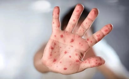 Nueva alerta sanitaria en Reino Unido por la detección de una cepa inédita de mpox
